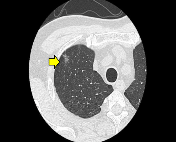 すりガラス陰影を呈する肺がんのCT画像(通常のレントゲン写真では検出できません)